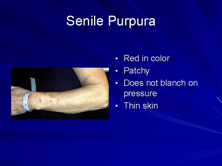 Senile Purpura • Red in color • Patchy • Does not blanch on pressure