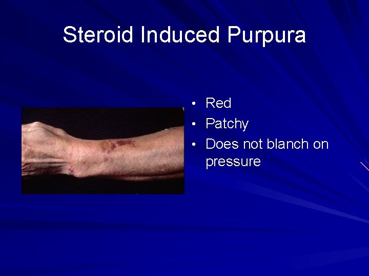 Steroid Induced Purpura • Red • Patchy • Does not blanch on pressure 