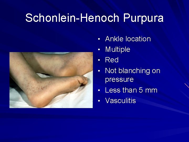 Schonlein-Henoch Purpura • Ankle location • Multiple • Red • Not blanching on pressure