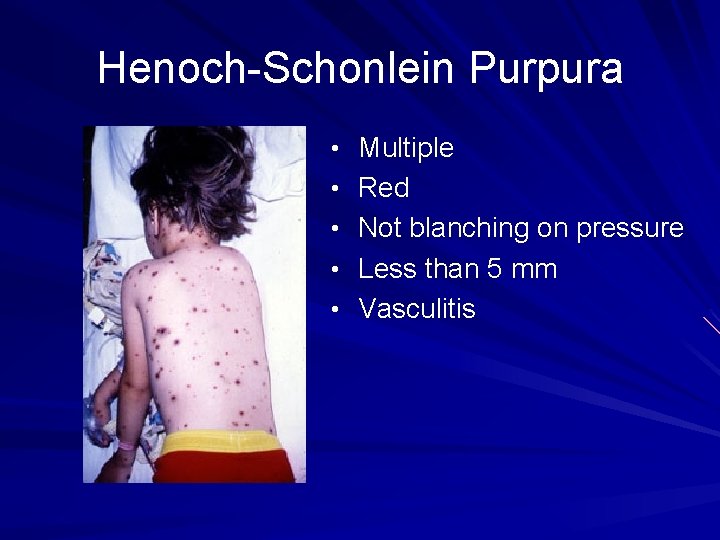 Henoch-Schonlein Purpura • Multiple • Red • Not blanching on pressure • Less than