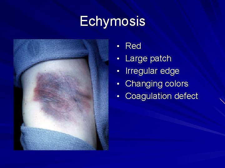 Echymosis • Red • Large patch • Irregular edge • Changing colors • Coagulation