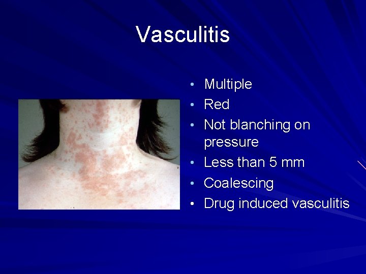 Vasculitis • Multiple • Red • Not blanching on pressure • Less than 5