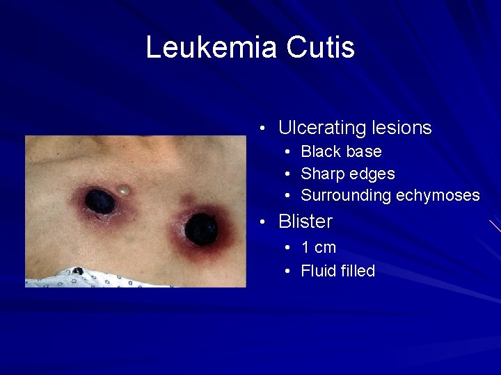 Leukemia Cutis • Ulcerating lesions • Black base • Sharp edges • Surrounding echymoses