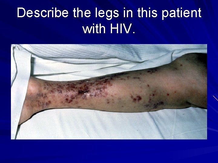 Describe the legs in this patient with HIV. 