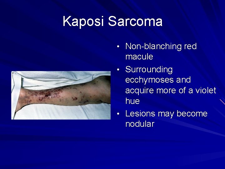 Kaposi Sarcoma • Non-blanching red macule • Surrounding ecchymoses and acquire more of a