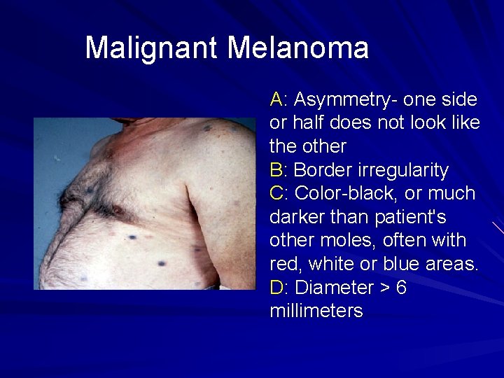 Malignant Melanoma A: Asymmetry- one side or half does not look like the other
