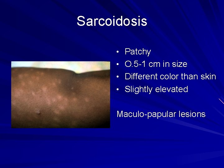 Sarcoidosis • Patchy • O. 5 -1 cm in size • Different color than