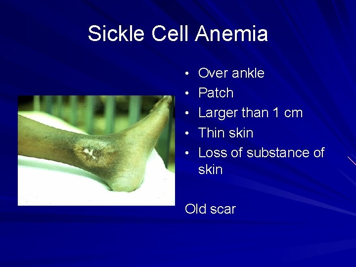 Sickle Cell Anemia • Over ankle • Patch • Larger than 1 cm •