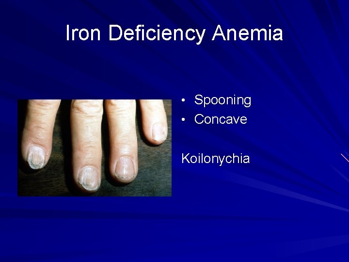 Iron Deficiency Anemia • Spooning • Concave Koilonychia 