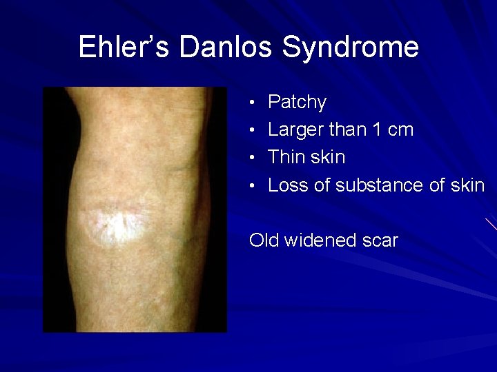 Ehler’s Danlos Syndrome • Patchy • Larger than 1 cm • Thin skin •