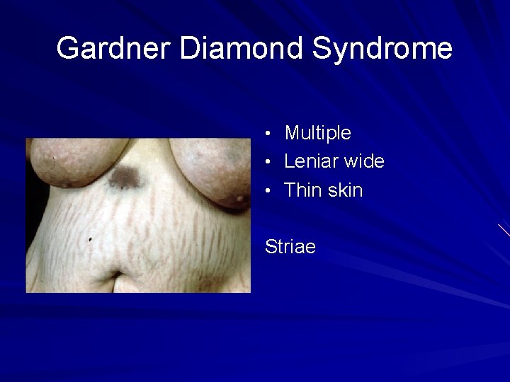 Gardner Diamond Syndrome • Multiple • Leniar wide • Thin skin Striae 