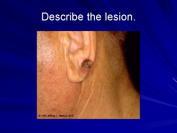 Describe the lesion. 