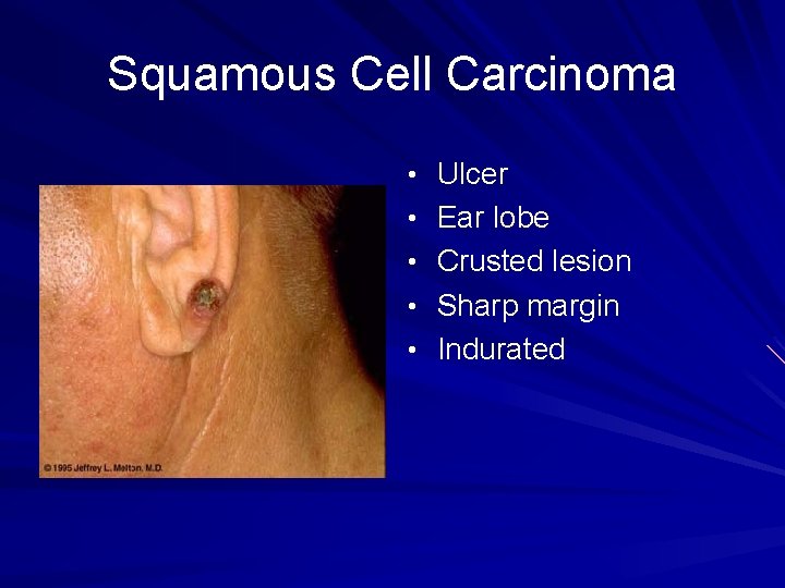 Squamous Cell Carcinoma • Ulcer • Ear lobe • Crusted lesion • Sharp margin