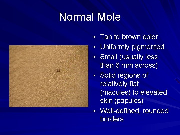 Normal Mole • Tan to brown color • Uniformly pigmented • Small (usually less