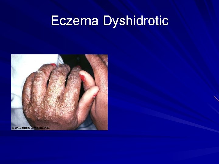 Eczema Dyshidrotic 