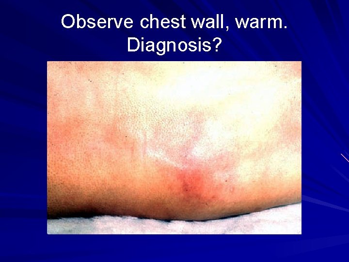 Observe chest wall, warm. Diagnosis? 