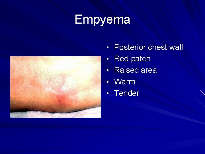 Empyema • Posterior chest wall • Red patch • Raised area • Warm •