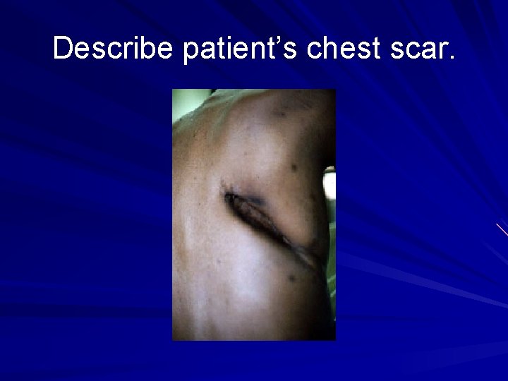 Describe patient’s chest scar. 