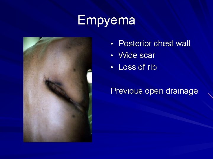 Empyema • Posterior chest wall • Wide scar • Loss of rib Previous open