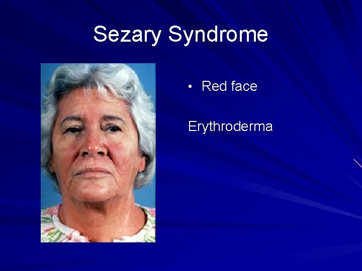 Sezary Syndrome • Red face Erythroderma 