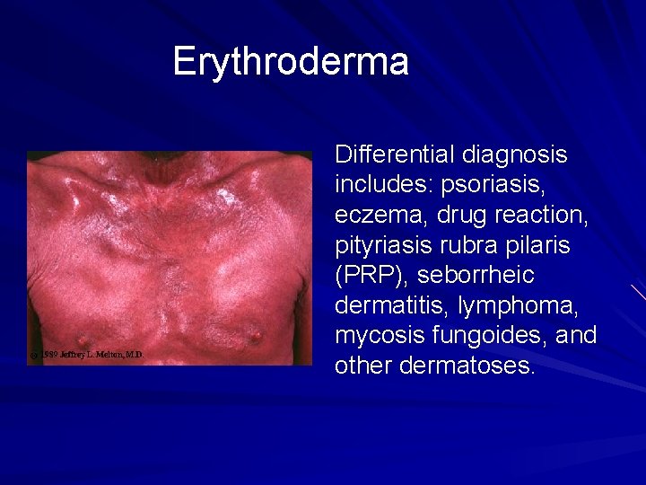 Erythroderma Differential diagnosis includes: psoriasis, eczema, drug reaction, pityriasis rubra pilaris (PRP), seborrheic dermatitis,