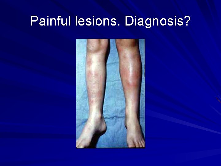 Painful lesions. Diagnosis? 