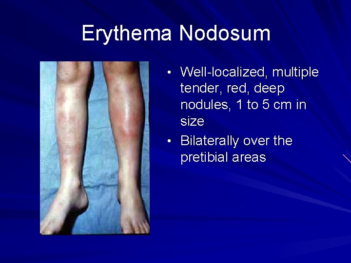 Erythema Nodosum • Well-localized, multiple tender, red, deep nodules, 1 to 5 cm in