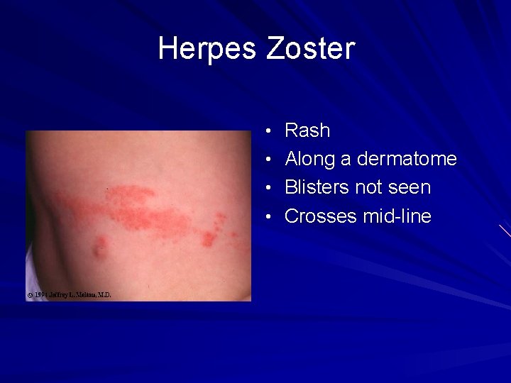 Herpes Zoster • Rash • Along a dermatome • Blisters not seen • Crosses