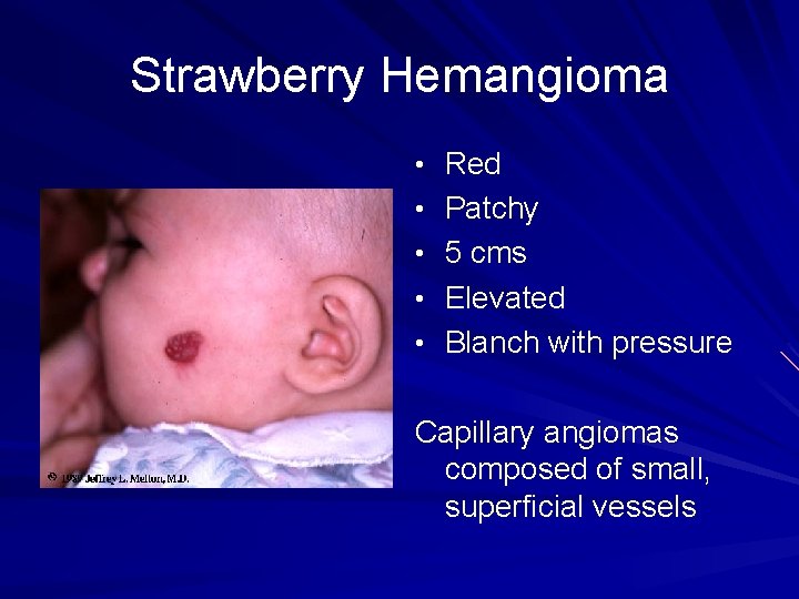 Strawberry Hemangioma • Red • Patchy • 5 cms • Elevated • Blanch with