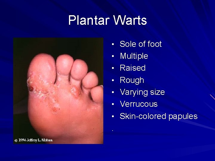 Plantar Warts • Sole of foot • Multiple • Raised • Rough • Varying