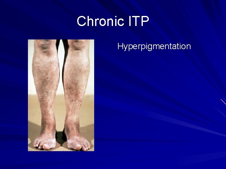 Chronic ITP Hyperpigmentation 