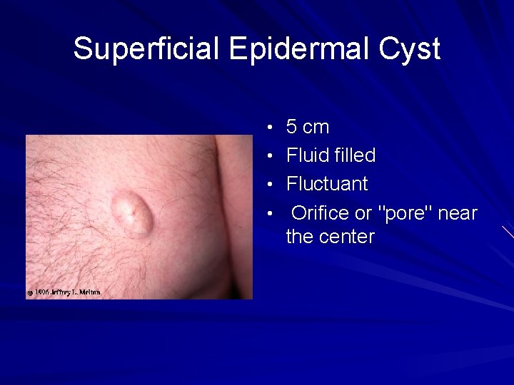 Superficial Epidermal Cyst • 5 cm • Fluid filled • Fluctuant • Orifice or