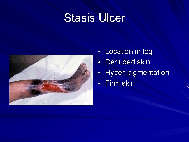 Stasis Ulcer • Location in leg • Denuded skin • Hyper-pigmentation • Firm skin