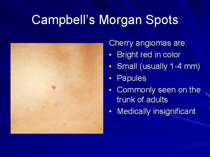 Campbell’s Morgan Spots Cherry angiomas are: • Bright red in color • Small (usually