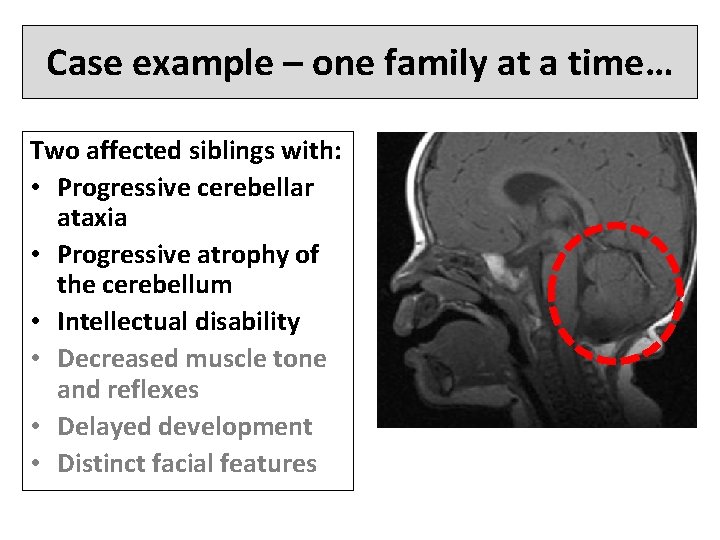 Case example – one family at a time… Two affected siblings with: • Progressive