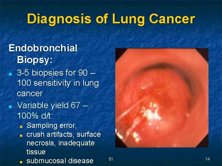 Diagnosis of Lung Cancer Endobronchial Biopsy: ■ ■ 3 -5 biopsies for 90 –