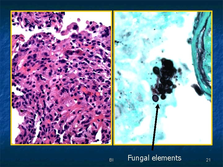 BI Fungal elements 21 