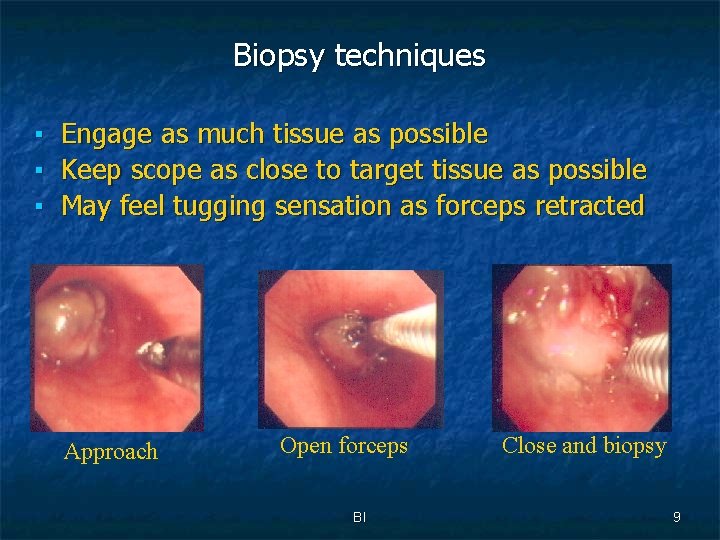 Biopsy techniques ▪ ▪ ▪ Engage as much tissue as possible Keep scope as
