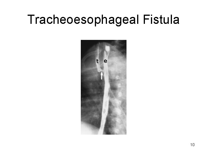 Tracheoesophageal Fistula 10 