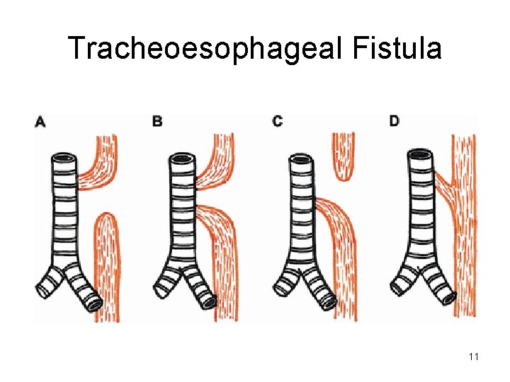 Tracheoesophageal Fistula 11 