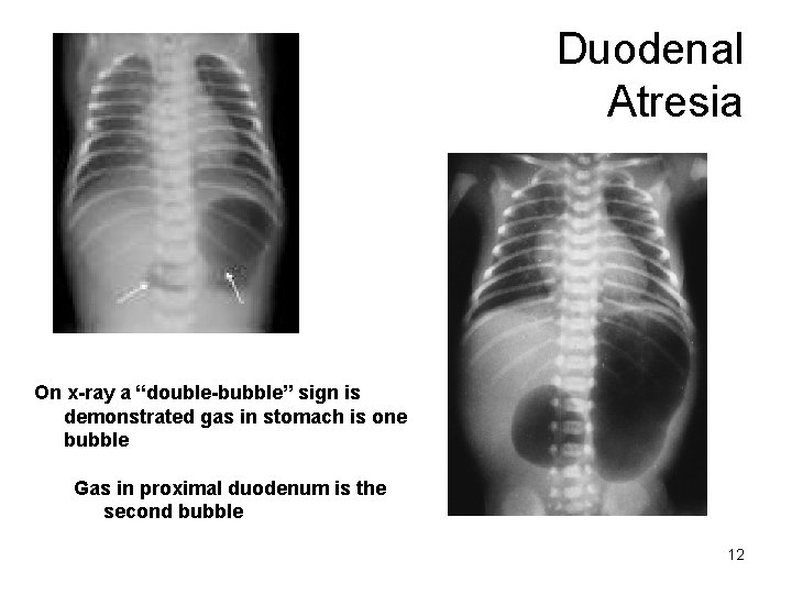 Duodenal Atresia On x-ray a “double-bubble” sign is demonstrated gas in stomach is one