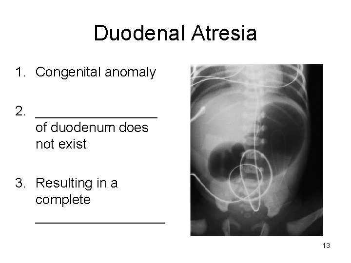 Duodenal Atresia 1. Congenital anomaly 2. ________ of duodenum does not exist 3. Resulting