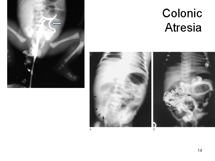 Colonic Atresia 14 