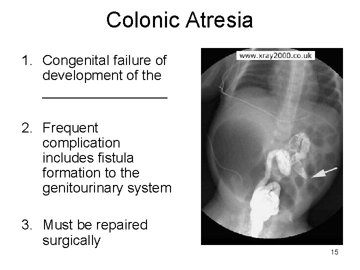 Colonic Atresia 1. Congenital failure of development of the ________ 2. Frequent complication includes
