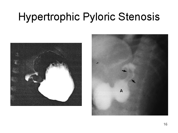 Hypertrophic Pyloric Stenosis 16 