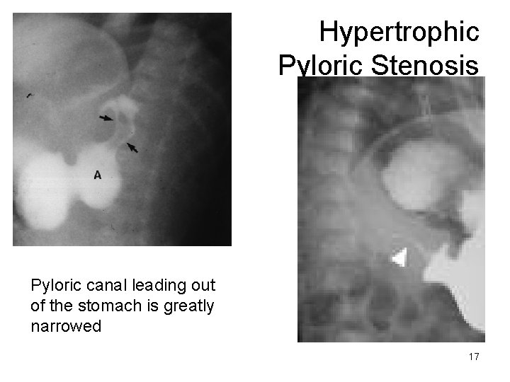 Hypertrophic Pyloric Stenosis Pyloric canal leading out of the stomach is greatly narrowed 17