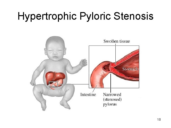 Hypertrophic Pyloric Stenosis 18 