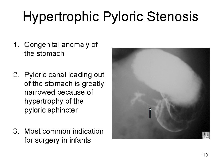 Hypertrophic Pyloric Stenosis 1. Congenital anomaly of the stomach 2. Pyloric canal leading out