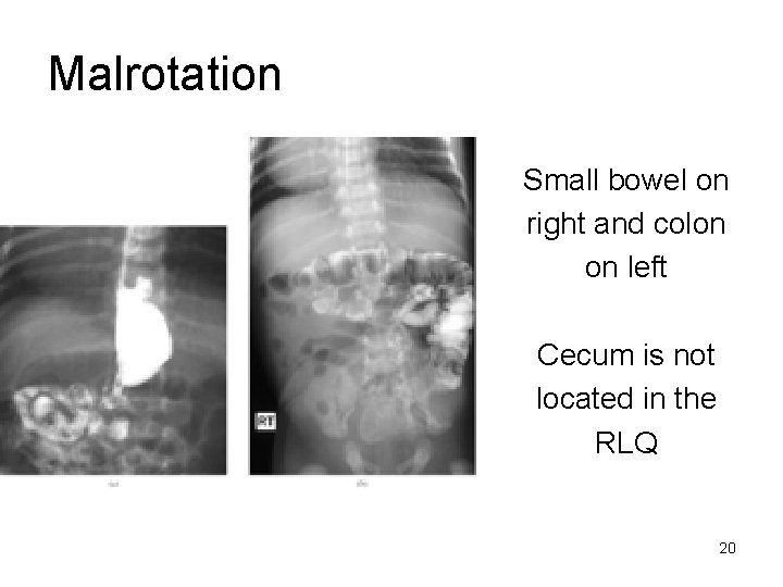 Malrotation Small bowel on right and colon on left Cecum is not located in
