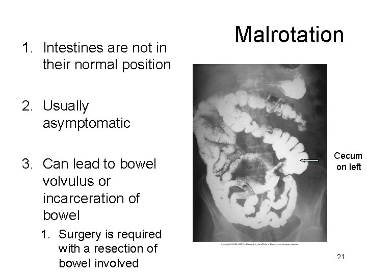 1. Intestines are not in their normal position Malrotation 2. Usually asymptomatic 3. Can